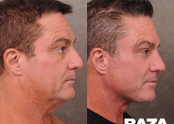 ŞOK TENDENSİYA: Kişilər işlərini itirməmək üçün plastik cərrahlara ÜZ TUTUR