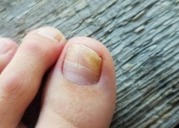 Pambıq və ya fırça ilə dırnağa çəkin – göbələyin kökünü kəsir