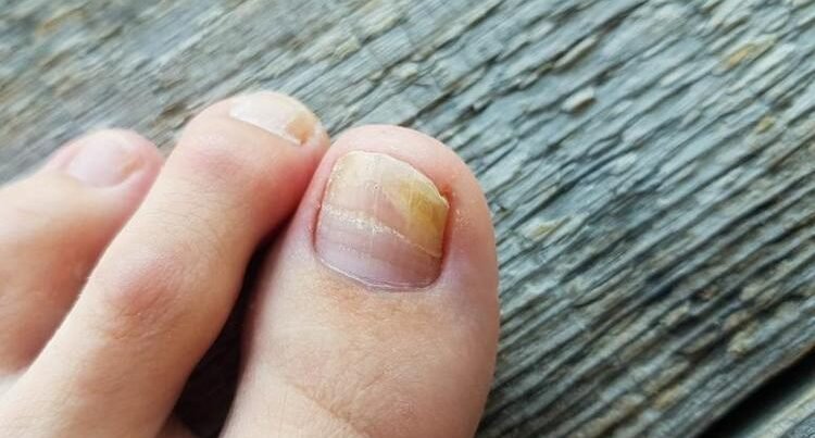 Pambıq və ya fırça ilə dırnağa çəkin – göbələyin kökünü kəsir