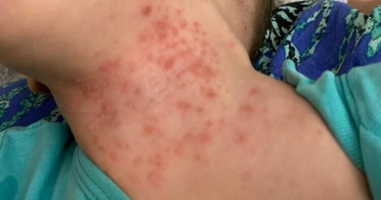 Uşaqlar arasında yeni virus yayılıb? – AÇIQLAMA