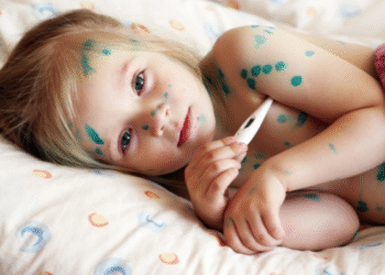 Azərbaycanda suçiçəyi yayılıb? – Rəsmi