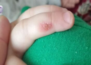 Bağça müəllimi bıçağı qızdırıb, 3 yaşlı uşağın əlinə basıb? – VİDEO