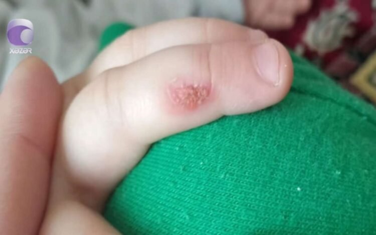 Bağça müəllimi bıçağı qızdırıb, 3 yaşlı uşağın əlinə basıb? – VİDEO