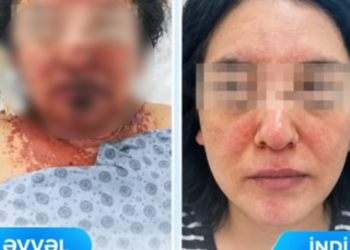 Dərman qəbulundan sonra ağır allergik reaksiya verdi – FOTO