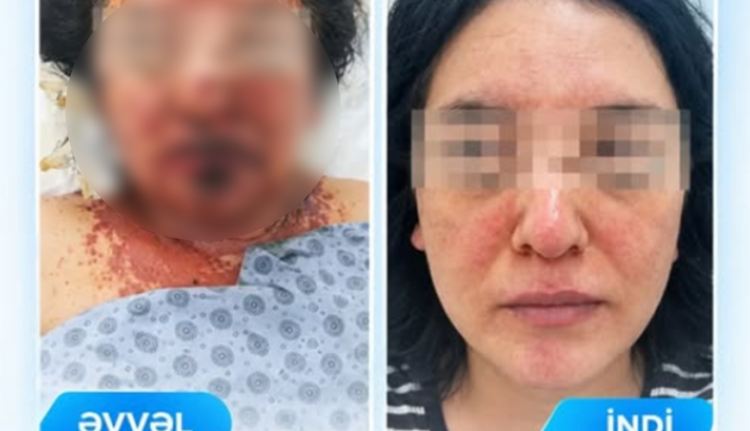 Dərman qəbulundan sonra ağır allergik reaksiya verdi – FOTO